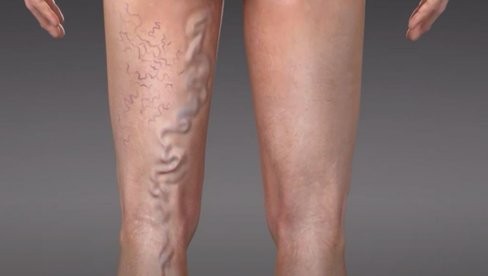 PROŠIRENE VENE NISU SAMO ESTETSKI PROBLEM: Posmatrajte svoje noge - Zbog poremećenog protoka krvi veći rizik od pojave tromba