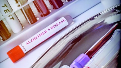 ALCAHAJMER I KOD MLADIH: Istraživanje američkioh naučnika dovelo do novih otkrića ALCAHAJMER I KOD MLADIH: Istraživanje američkioh naučnika dovelo do novih otkrića