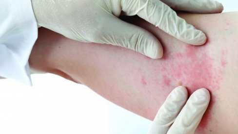 ТИФУС ЈЕ ЗАРАЗА КОЈА СЕ БРЗО ШИРИ: Први симптоми се појаве тек после седам дана - исход може бити фаталан