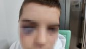 ДЕЧАКУ ОКО МОДРО И ЗАТВОРЕНО: Отац из Сурдулице пријавио да му је дете (15) жртва вршњачког насиља (ФОТО)