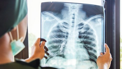SKRINING NA RANO OTKRIVANJE RAKA PLUĆA: Prošlo više od 2.200 građana u riziku