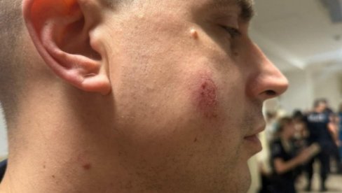 РАСТЕ БРОЈ ПОВРЕЂЕНИХ ПОЛИЦАЈЦА У ПАНЧЕВУ! Један гађан каменом у главу - језиво (ФОТО) РАСТЕ БРОЈ ПОВРЕЂЕНИХ ПОЛИЦАЈЦА У ПАНЧЕВУ! Један гађан каменом у главу - језиво (ФОТО)