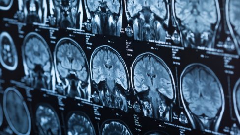 НАУЧНИЦИ ОТКРИЛИ ШТА СЕ ДЕШАВА ПОСЛЕ СМРТИ: Мозак задржава степен свести након што лекари прогласе пацијента мртвим