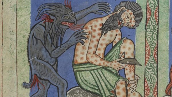 ПОЗНАТО СТАЊЕ ЧОВЕКА ЗАРАЖЕНОГ ГУБОМ У ХРВАТСКОЈ: Цело тело му у флекама, ево да ли може доћи до епидемије