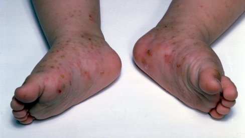 DODIR JE DOVOLJAN DA SE ZARAZITE: Buknula šuga u srpskom komšiluku