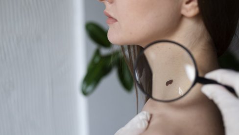 ОПРЕЗНО СА ПРОМЕНАМА НА КОЖИ: Постоји само један сигуран начин уклањања младежа (ФОТО)