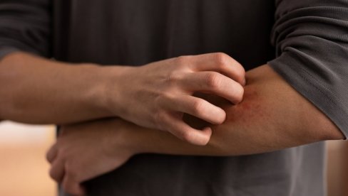 NEKAD JE ČAK ZNAK I UNUTRAŠNJIH BOLESTI: Ne zanemarujte kada vas svrbi koža, možda imate neke od ovih problema